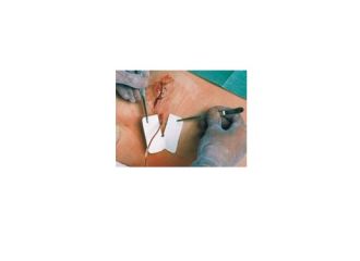 Medicazione per tubi di drenaggio fessurata metalline drain 6x7cm foro 4,5x11mm 50 pezzi